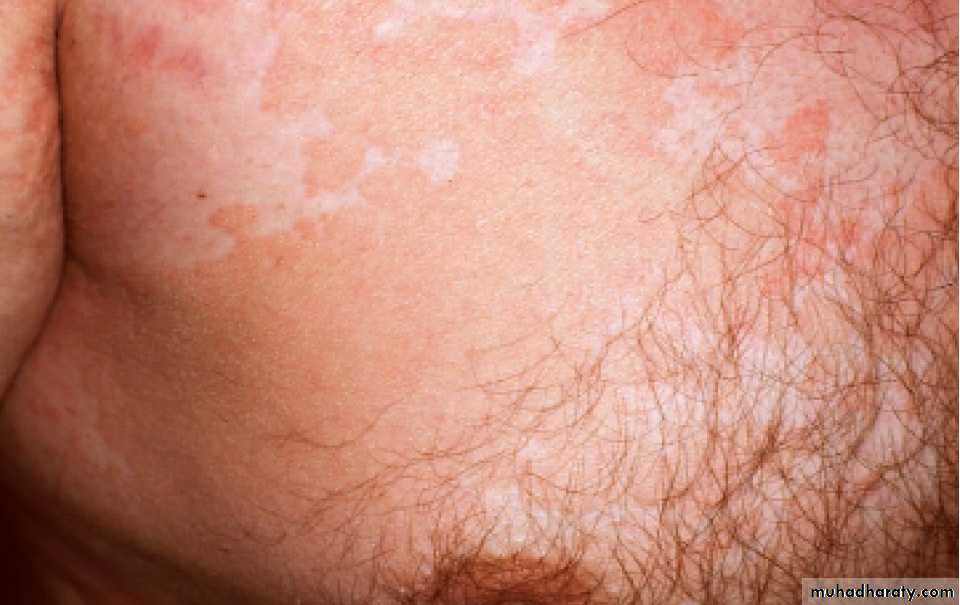 Fungal Infections