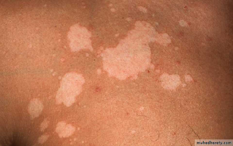 Fungal Infections