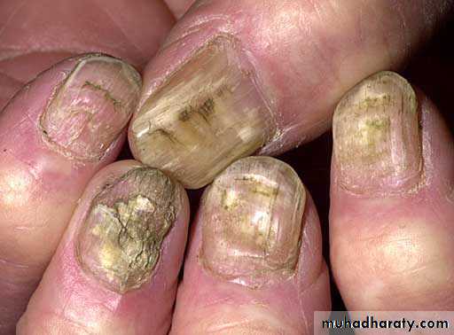 Fungal Infections