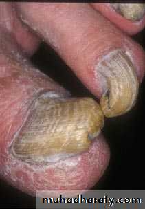 Fungal Infections
