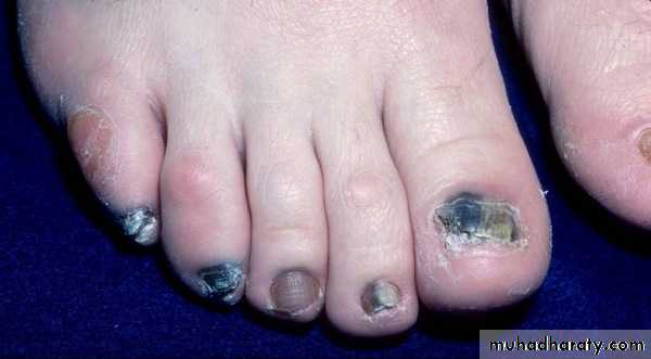 Fungal Infections