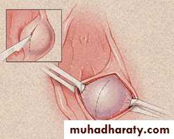 Vaginal diseases