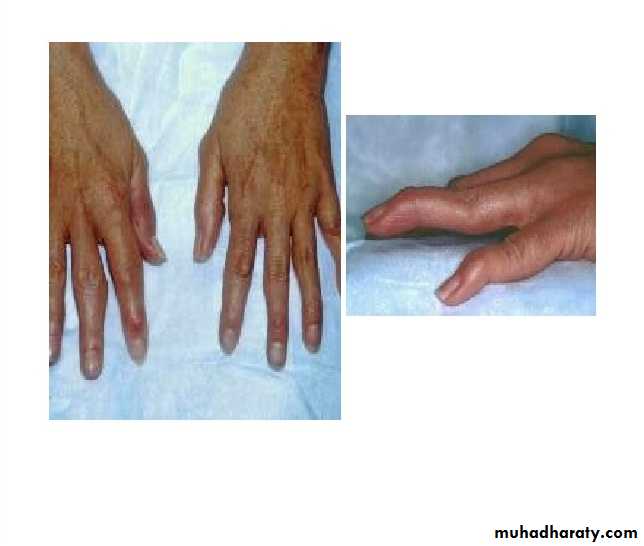 Rheumatoid arthritis