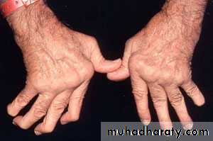 Rheumatoid arthritis