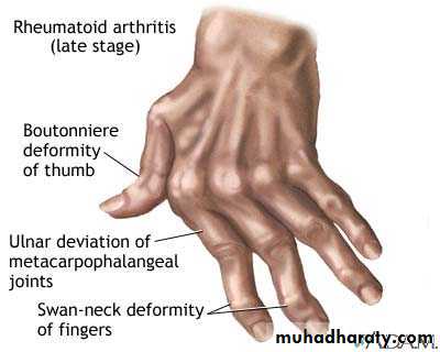 Rheumatoid arthritis