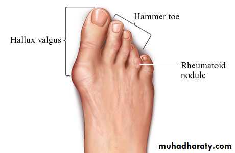 Rheumatoid arthritis