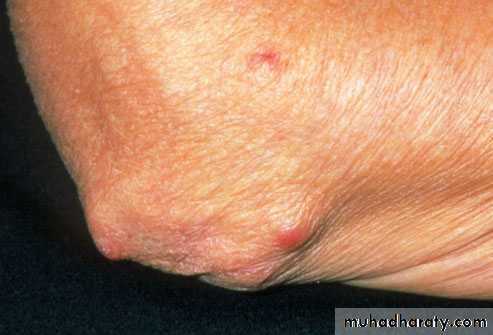 Rheumatoid arthritis