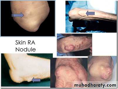 Rheumatoid arthritis