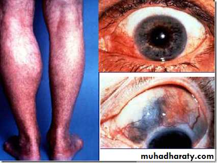 Rheumatoid arthritis