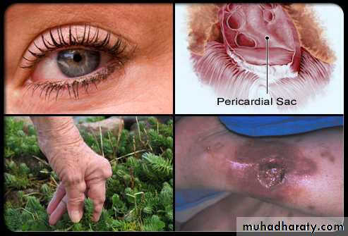 Rheumatoid arthritis