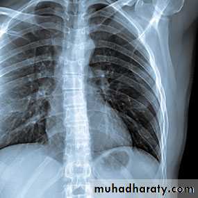 Rheumatoid arthritis