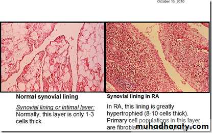 Rheumatoid arthritis