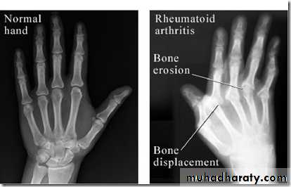 Rheumatoid arthritis