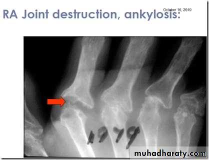Rheumatoid arthritis