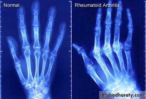 Rheumatoid arthritis