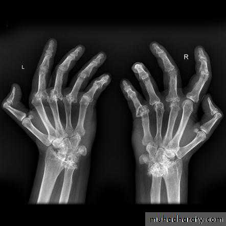 Rheumatoid arthritis