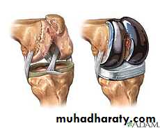 Rheumatoid arthritis