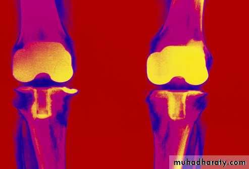 Rheumatoid arthritis