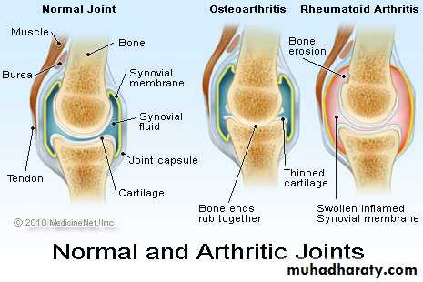 Rheumatoid arthritis