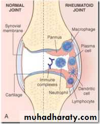 Rheumatoid arthritis