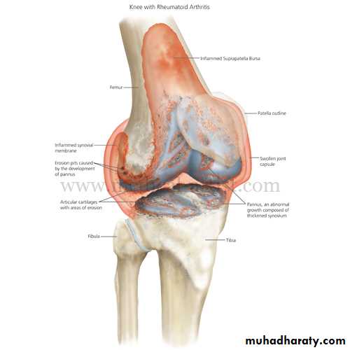 Rheumatoid arthritis