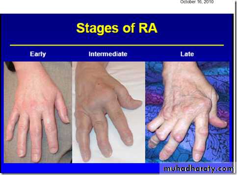 Rheumatoid arthritis