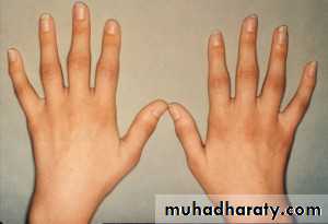 Rheumatoid arthritis