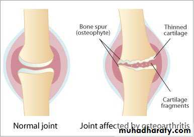 Osteoarthritis