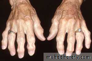 Osteoarthritis
