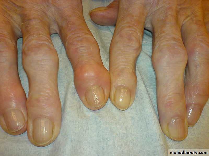 Osteoarthritis