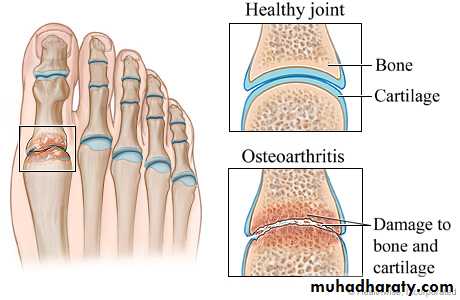 Osteoarthritis