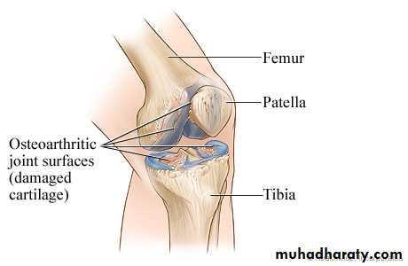 Osteoarthritis