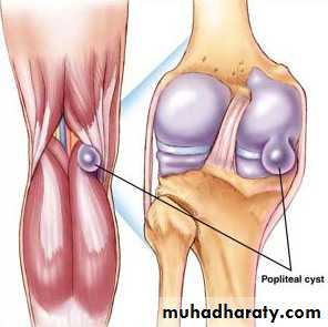 Osteoarthritis