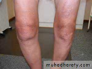 Osteoarthritis