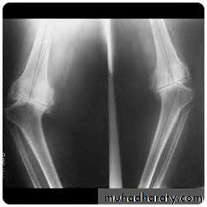Osteoarthritis