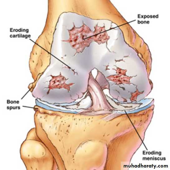 Osteoarthritis