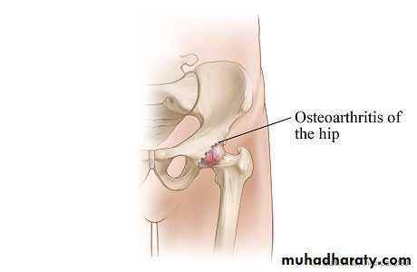 Osteoarthritis