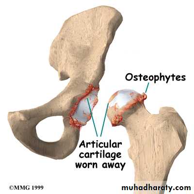 Osteoarthritis
