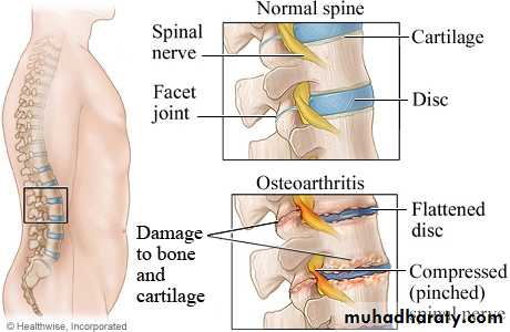 Osteoarthritis