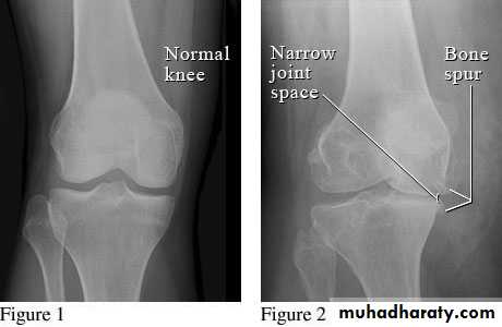 Osteoarthritis