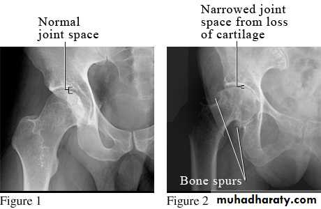 Osteoarthritis