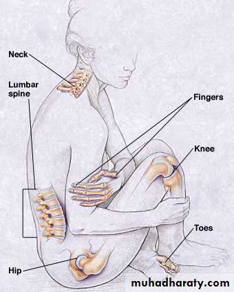 Osteoarthritis