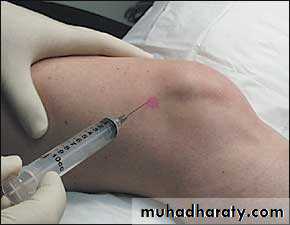 Osteoarthritis