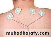 Osteoarthritis