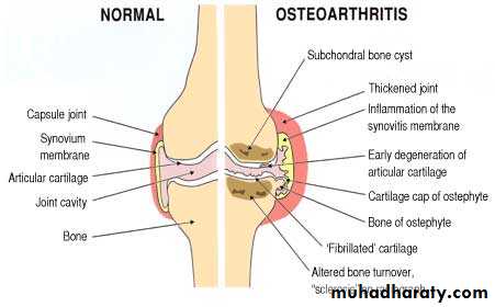 Osteoarthritis