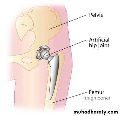 Osteoarthritis