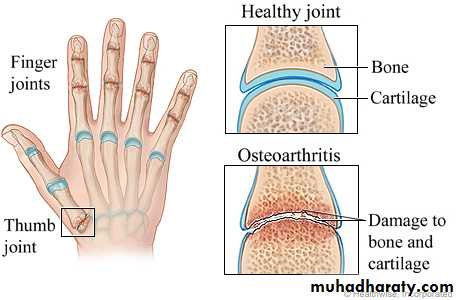 Osteoarthritis