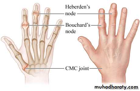 Osteoarthritis