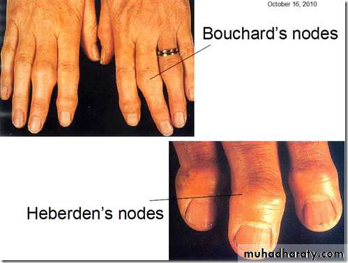 Osteoarthritis