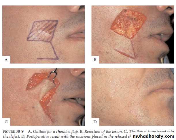 Basic principles in plastic surgery